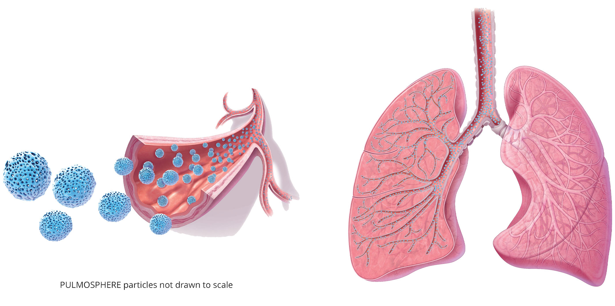 Image of lungs showing pulmosphere particles being delivered to airways